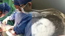 49岁男子洗澡时发现胸口有肿块 入院后确诊乳腺癌